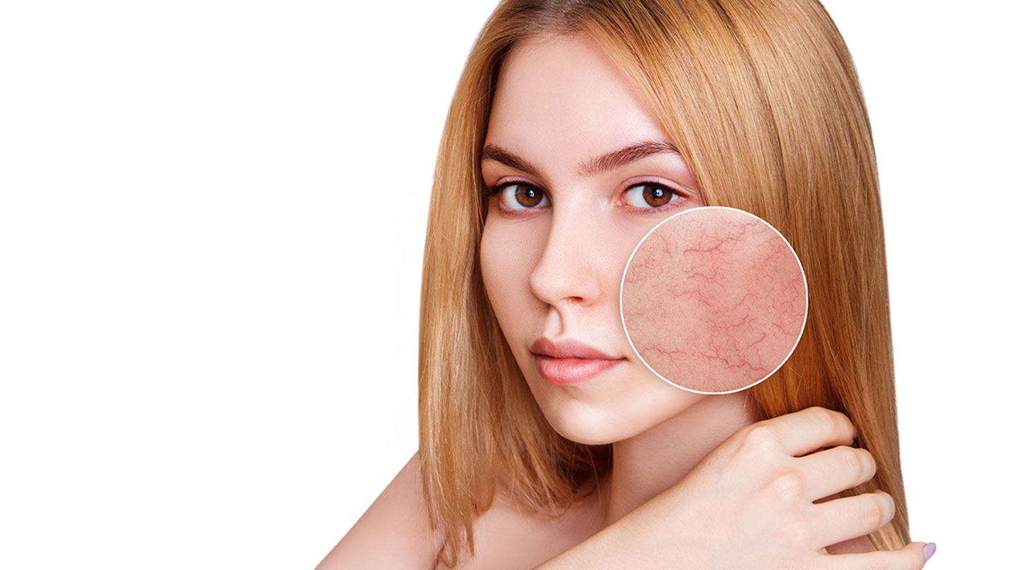 Rosacea erkennen und behandeln